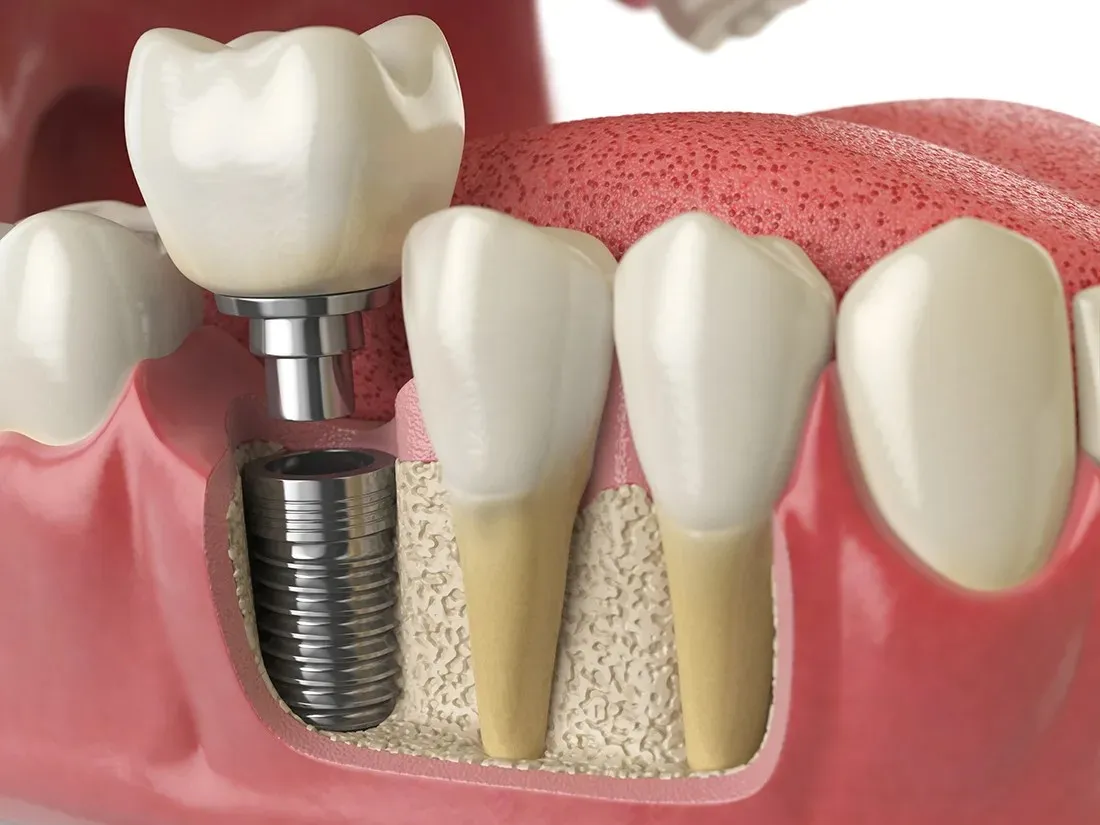 Best Dental Implants in Tewksbury