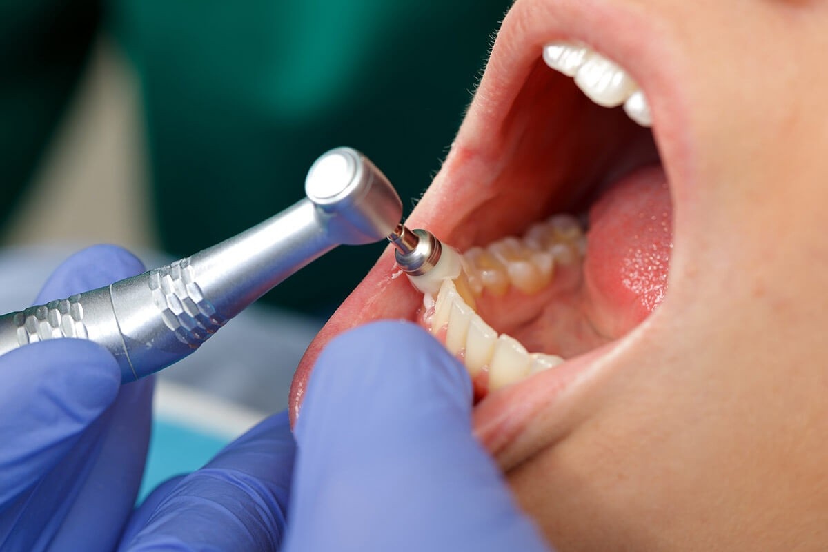Best Dental Treatment in United States