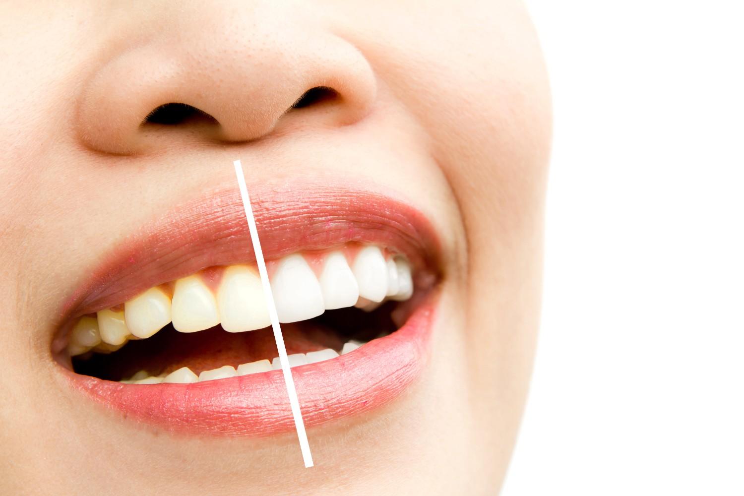 Best Teeth Whitening Clinic in United States