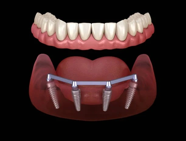 Dental Implants in Tewksbury