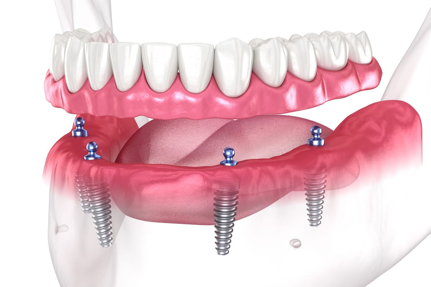 Best Dental Implants in Tewksbury