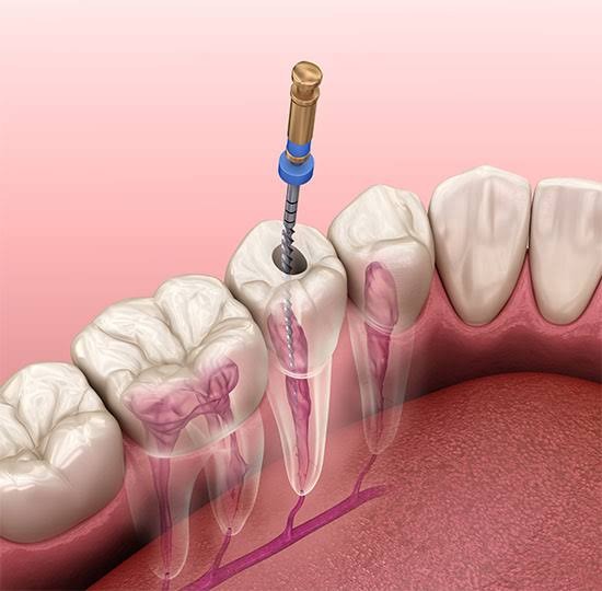 Root Canal Treatment in Tewksbury