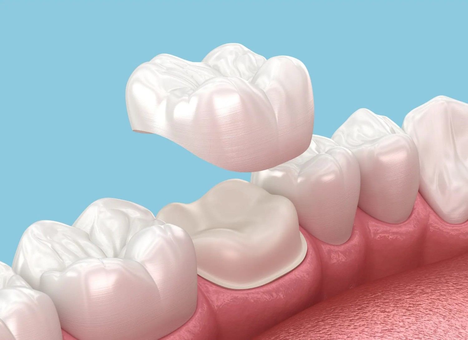 Dental Crowns in Tewksbury