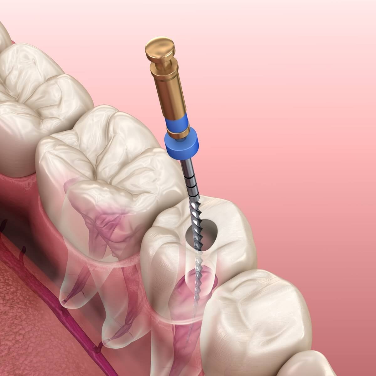 Root Canal in Tewksbury